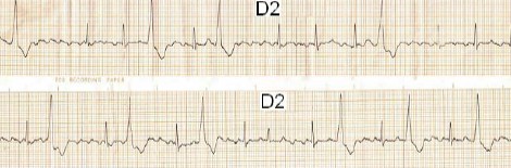 ECG_arritmias_supraventriculares/flutter_auricular.