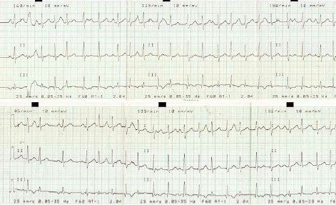 ECG_arritmias_supraventriculares/taquicardia_atrial_auricular ECG_arritmias_supraventriculares/taquicardia_atrial_auricular