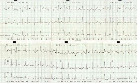 ECG_arritmias_supraventriculares/taquicardia_atrial_auricular