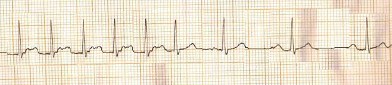 ECG_arritmias_supraventriculares/taquicardia_paroxistica_auricular ECG_arritmias_supraventriculares/taquicardia_paroxistica_auricular