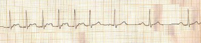 ECG_arritmias_supraventriculares/taquicardia_paroxistica_auricular