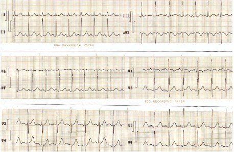 ECG_arritmias_supraventriculares/taquicardia_sinusal