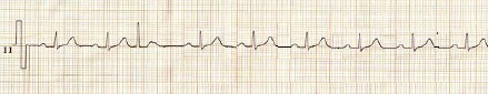 ECG_arritmias_union/extrasistole_union