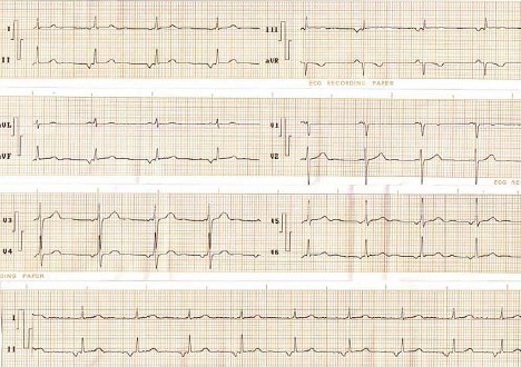 ECG_arritmias_union/ritmo_supraunion.