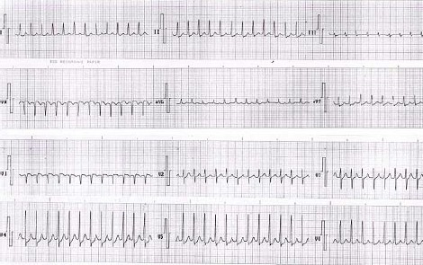 ECG_arritmias_union/taquicardia_paroxistica_union