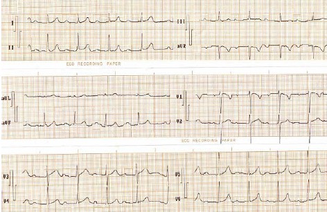 ECG_bloqueos_auriculoventricular/bloqueo_AV_primer_grado