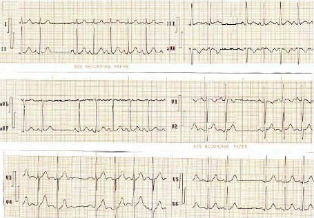 ECG_bloqueos_auriculoventricular/bloqueo_AV_segundo_grado