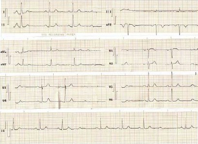 ECG_bloqueos_auriculoventricular/bloqueo_AV_segundo_grado_Mobitz ECG_bloqueos_auriculoventricular/bloqueo_AV_segundo_grado_Mobitz