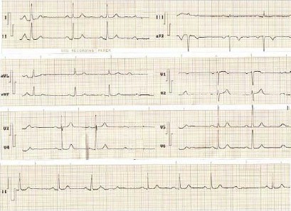 ECG_bloqueos_auriculoventricular/bloqueo_AV_segundo_grado_Mobitz