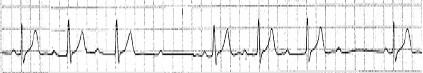 ECG_bloqueos_auriculoventricular/bloqueo_segundo_grado_Mobitz