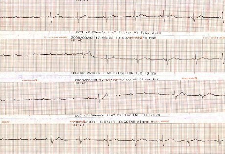 ECG_bloqueos_auriculoventricular/bloqueo_tercer_grado_completo ECG_bloqueos_auriculoventricular/bloqueo_tercer_grado_completo