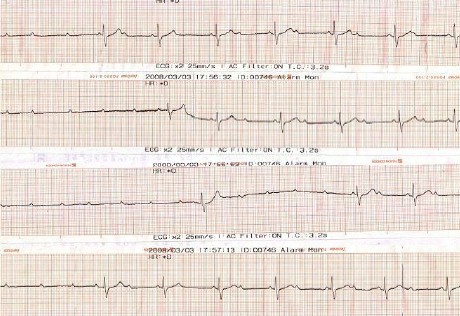 ECG_bloqueos_auriculoventricular/bloqueo_tercer_grado_completo