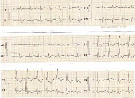 ECG_bloqueos_bloqueo/bifascicular_bifasciculares