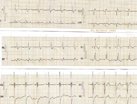 ECG_bloqueos_bloqueo/completo_rama_derecha