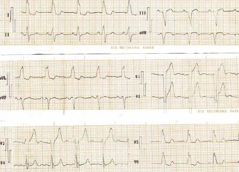 ECG_bloqueos_bloqueo/completo_rama_izquierda