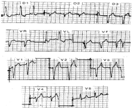 ECG_bloqueos_bloqueo/fascicular_anterior_izquierdo