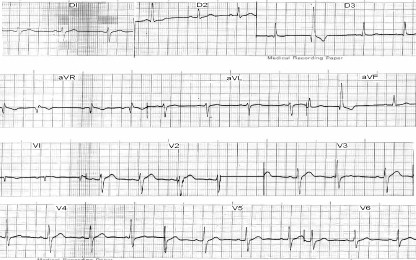 ECG_bloqueos_bloqueo/fascicular_posterior_izquierdo