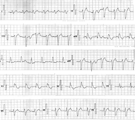 ECG_bloqueos_bloqueo/trifascicular_trifasciculares