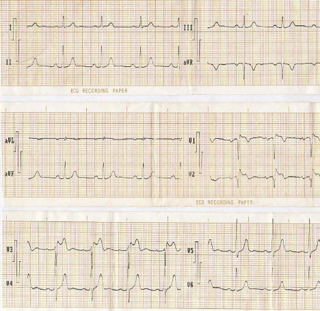 ECG_sindrome_brugada/EKG_pseudobrugada ECG_sindrome_brugada/EKG_pseudobrugada