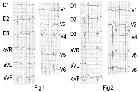 ECG_sindrome_brugada/administracion_ajmalina ECG_sindrome_brugada/administracion_ajmalina