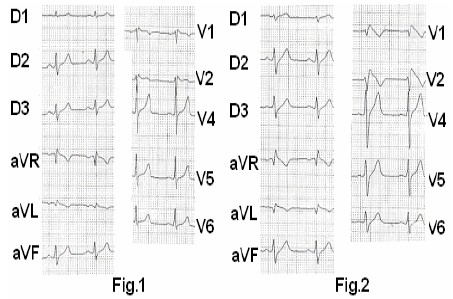 ECG_sindrome_brugada/administracion_ajmalina