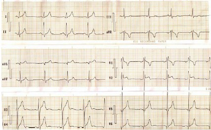 ECG_sindrome_brugada/despolarizacion_precoz ECG_sindrome_brugada/despolarizacion_precoz