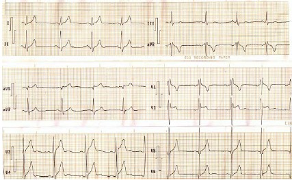 ECG_sindrome_brugada/despolarizacion_precoz