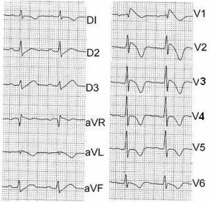 ECG_sindrome_brugada/supradesnivelacion_ST