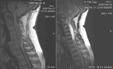 RMN_astrocitoma_medular/RMI_tumor_resonancia_magnetica RMN_astrocitoma_medular/RMI_tumor_resonancia_magnetica