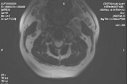 RMN_astrocitoma_medular/tumor_resonancia_magnetica