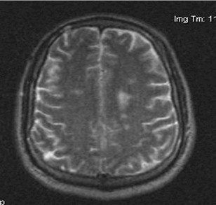 caso_esclerosis_multiple/RMN_RMI_NMR caso_esclerosis_multiple/RMN_RMI_NMR