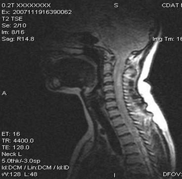 caso_esclerosis_multiple/brote_medula_espinal