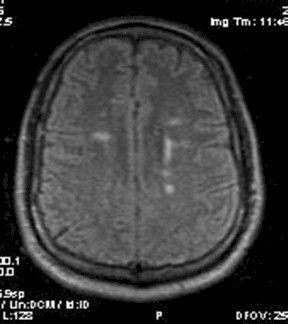 caso_esclerosis_multiple/imagen_resonancia_magnetica