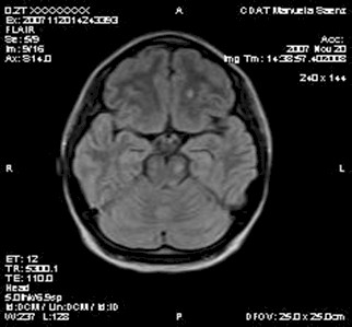 caso_esclerosis_multiple/resonancia_magnetica_imagenes caso_esclerosis_multiple/resonancia_magnetica_imagenes
