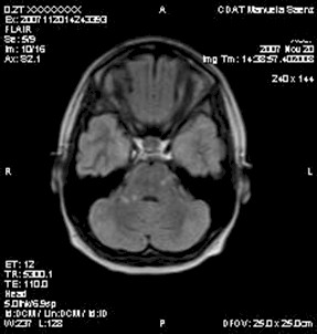 caso_esclerosis_multiple/resonancia_magnetica_nuclear caso_esclerosis_multiple/resonancia_magnetica_nuclear