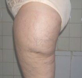 caso_lipodistrofia_trocanterea/paniculopatia_aspecto_preoperatorio caso_lipodistrofia_trocanterea/paniculopatia_aspecto_preoperatorio