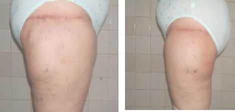caso_lipodistrofia_trocanterea/paniculopatia_resultados_quirurgicos caso_lipodistrofia_trocanterea/paniculopatia_resultados_quirurgicos