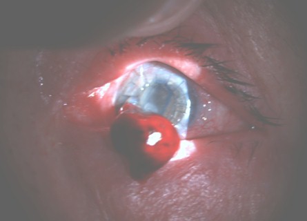 hemorragia_expulsiva_tardia/ocular_lampara_hendidura hemorragia_expulsiva_tardia/ocular_lampara_hendidura