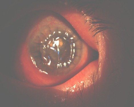 hemorragia_expulsiva_tardia/ojo_izquierdo_derecho