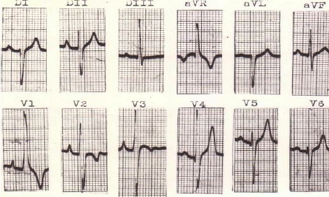 hipertrofia_auricular_ventricular/ECG_HVC_ventriculo_derecho hipertrofia_auricular_ventricular/ECG_HVC_ventriculo_derecho