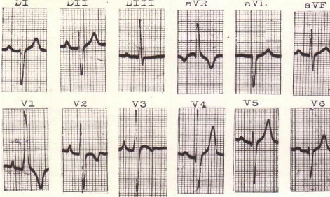 hipertrofia_auricular_ventricular/ECG_HVC_ventriculo_derecho