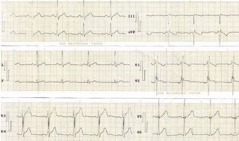 hipertrofia_auricular_ventricular/ECG_HVC_ventriculo_izquierdo hipertrofia_auricular_ventricular/ECG_HVC_ventriculo_izquierdo