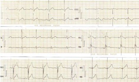 hipertrofia_auricular_ventricular/ECG_HVC_ventriculo_izquierdo