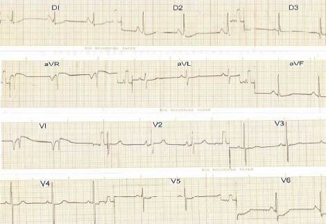 hipertrofia_auricular_ventricular/ECG_crecimiento_biauricular hipertrofia_auricular_ventricular/ECG_crecimiento_biauricular