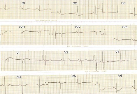 hipertrofia_auricular_ventricular/ECG_crecimiento_biauricular