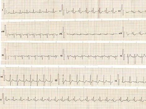 hipertrofia_auricular_ventricular/HAD_auricula_atrial_derecha