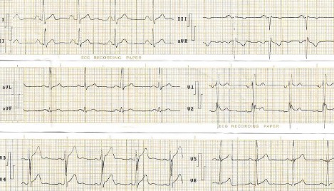 hipertrofia_auricular_ventricular/HAD_auricula_atrial_izquierda