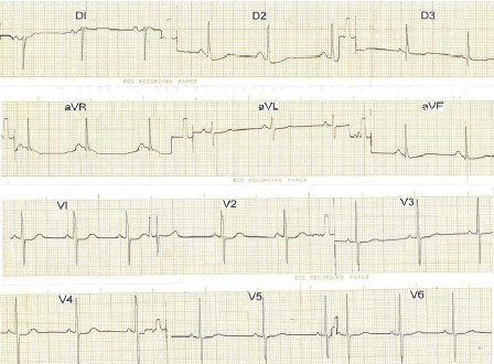 hipertrofia_auricular_ventricular/biventricular_ECG_EKG