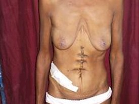 nutricion_enteral_precoz/malnutricion_desnutricion_perioperatoria nutricion_enteral_precoz/malnutricion_desnutricion_perioperatoria