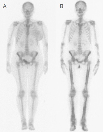 osteoartropatia_hipertrofica_paraneoplasica/gammagrafia_osea_completa osteoartropatia_hipertrofica_paraneoplasica/gammagrafia_osea_completa